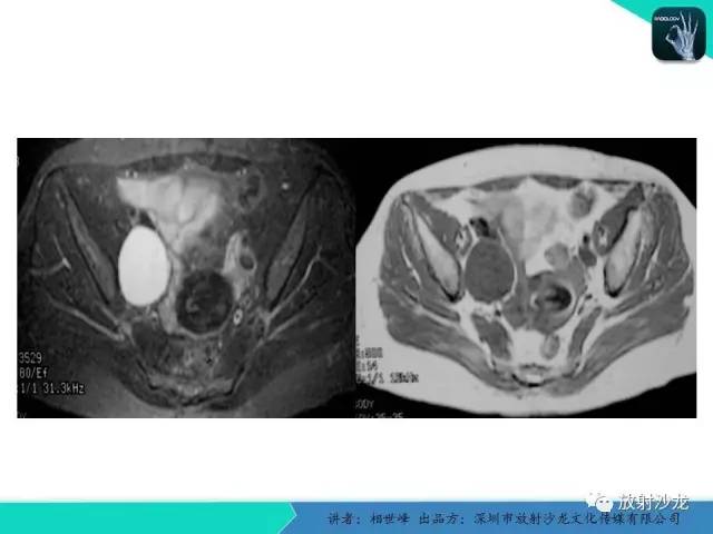 【PPT】女性盆腔非生殖系统肿瘤 的MRI诊断