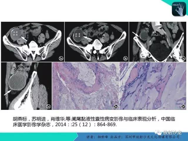 【PPT】女性盆腔非生殖系统肿瘤 的MRI诊断