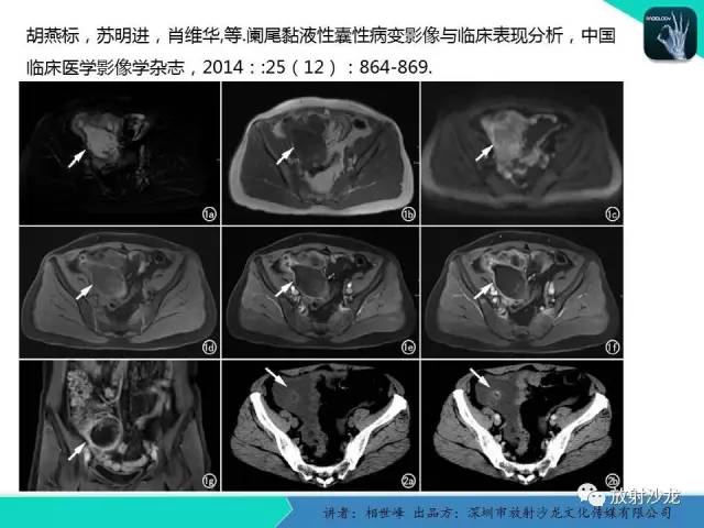 【PPT】女性盆腔非生殖系统肿瘤 的MRI诊断