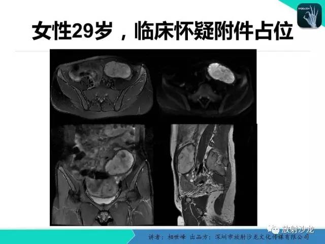 【PPT】女性盆腔非生殖系统肿瘤 的MRI诊断