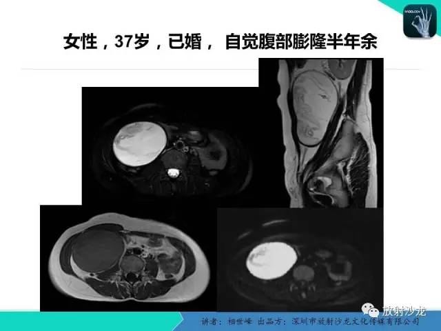 【PPT】女性盆腔非生殖系统肿瘤 的MRI诊断