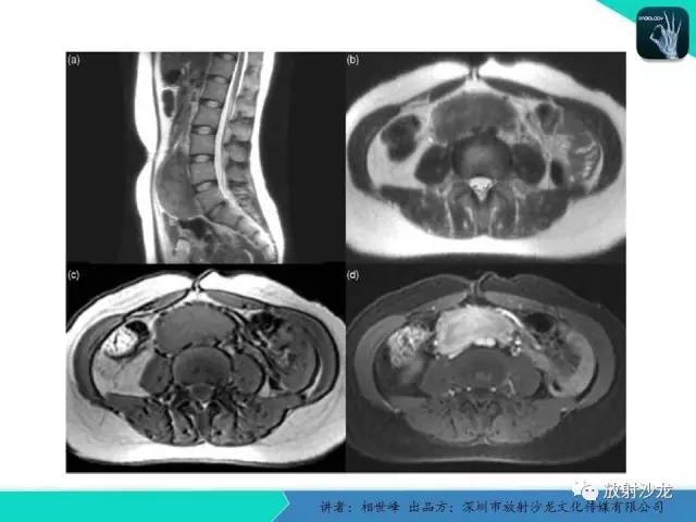 【PPT】女性盆腔非生殖系统肿瘤 的MRI诊断