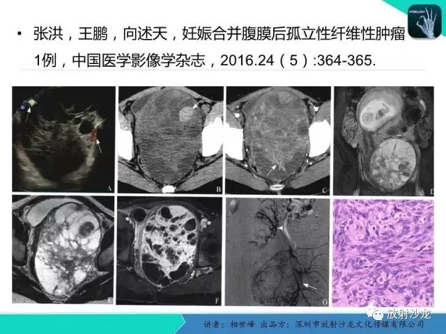 【PPT】女性盆腔非生殖系统肿瘤 的MRI诊断