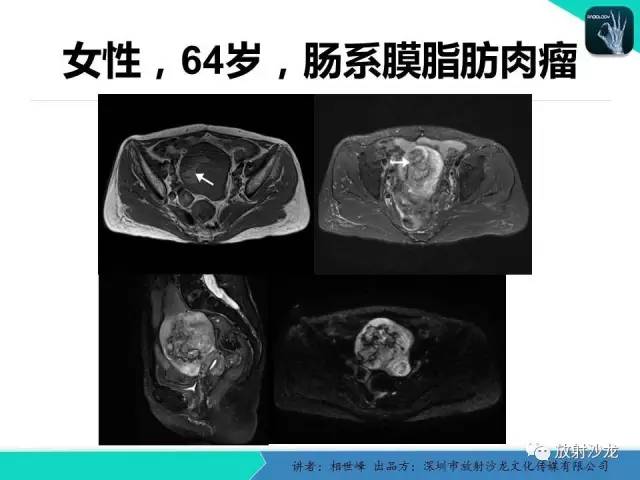 【PPT】女性盆腔非生殖系统肿瘤 的MRI诊断