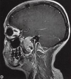 【病例】咽旁异位性室管膜瘤1例MR影像表现 【病例】咽旁异位性室管膜瘤1例MR影像表现