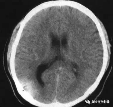 27种引起脑室扩大的病变 27种引起脑室扩大的病变