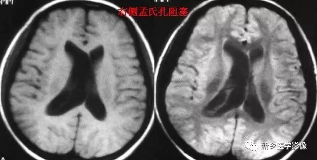 27种引起脑室扩大的病变 27种引起脑室扩大的病变
