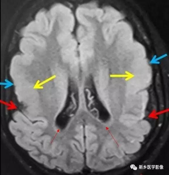 27种引起脑室扩大的病变 27种引起脑室扩大的病变
