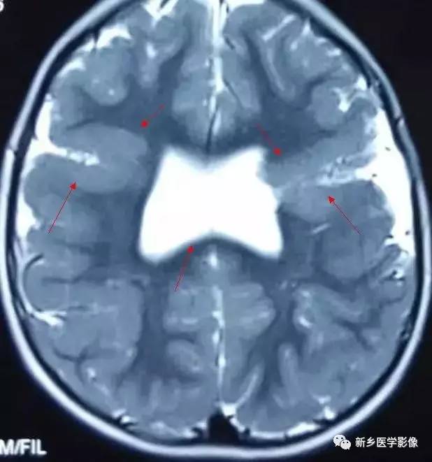 27种引起脑室扩大的病变 27种引起脑室扩大的病变