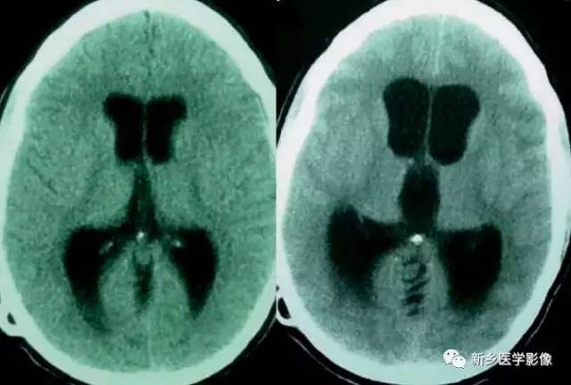 27种引起脑室扩大的病变 27种引起脑室扩大的病变