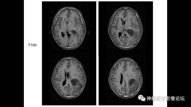 【病例】左侧顶枕叶转移性小细胞癌一例MR影像讨论