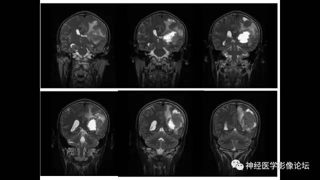 【病例】左侧顶枕叶转移性小细胞癌一例MR影像讨论