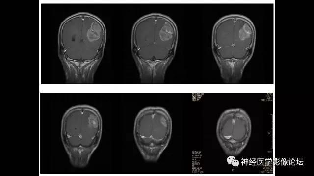【病例】左侧顶枕叶转移性小细胞癌一例MR影像讨论