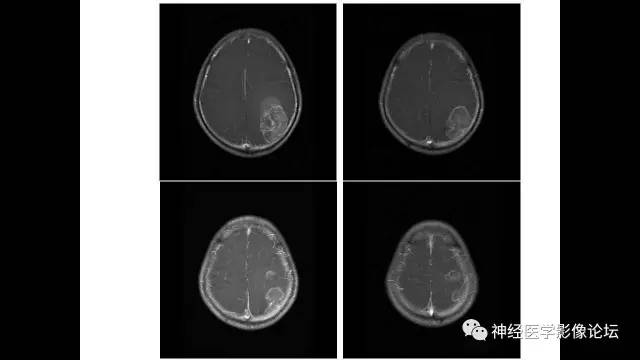【病例】左侧顶枕叶转移性小细胞癌一例MR影像讨论