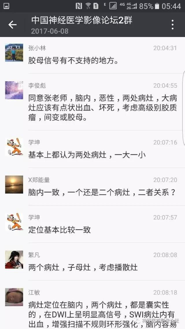 【病例】左侧顶枕叶转移性小细胞癌一例MR影像讨论