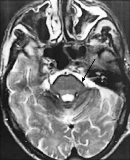 影像解析:中枢神经系统含铁血黄素沉积症 影像解析:中枢神经系统含铁血黄素沉积症