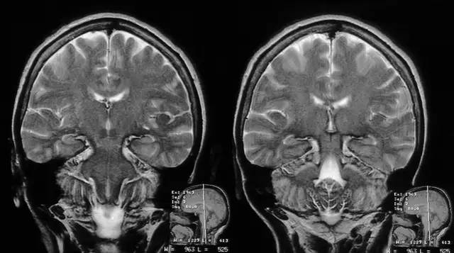 影像解析:中枢神经系统含铁血黄素沉积症 影像解析:中枢神经系统含铁血黄素沉积症