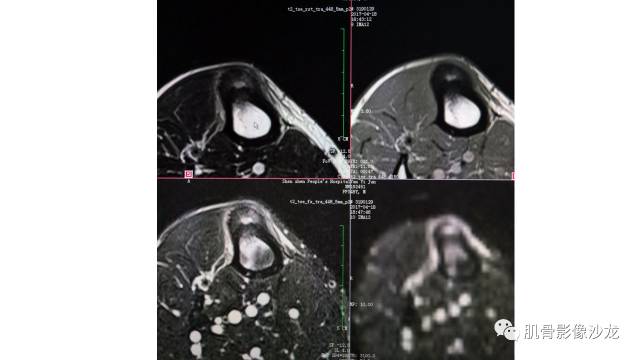 【病例】骨样骨瘤两例X线CT及MR