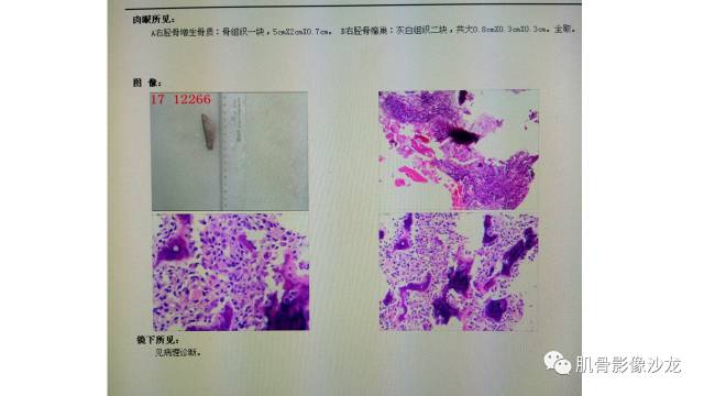 【病例】骨样骨瘤两例X线CT及MR