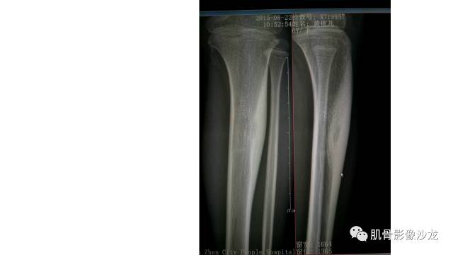 【病例】骨样骨瘤两例X线CT及MR