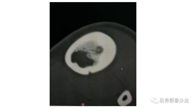 【病例】骨样骨瘤两例X线CT及MR