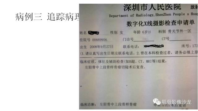 【病例】骨样骨瘤两例X线CT及MR