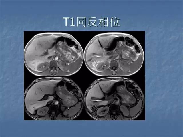 【病例】左肾上极、肾门及髂腰肌多发副神经节瘤1例MR