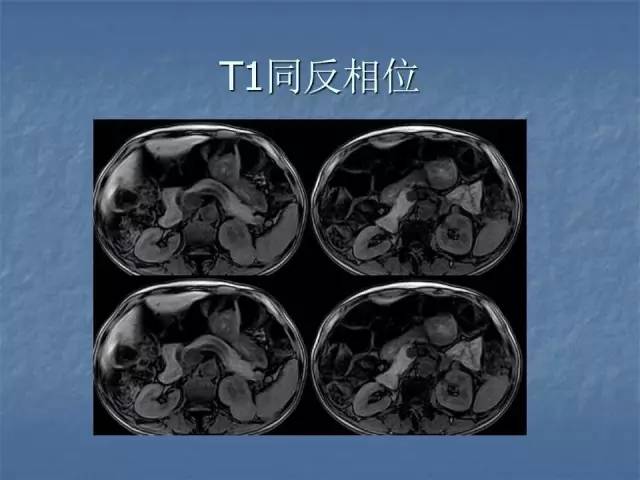 【病例】左肾上极、肾门及髂腰肌多发副神经节瘤1例MR