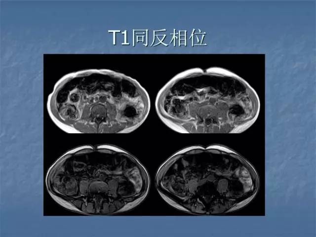【病例】左肾上极、肾门及髂腰肌多发副神经节瘤1例MR