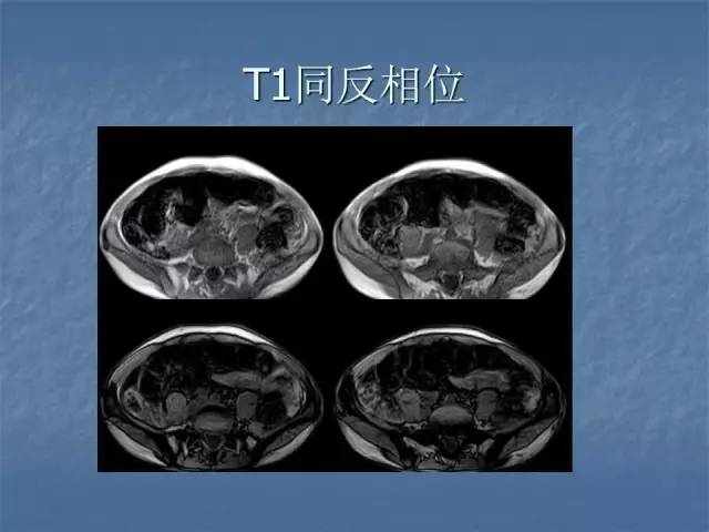 【病例】左肾上极、肾门及髂腰肌多发副神经节瘤1例MR