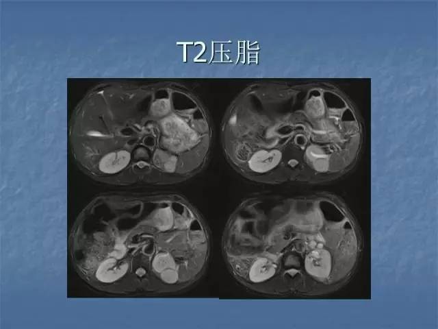【病例】左肾上极、肾门及髂腰肌多发副神经节瘤1例MR