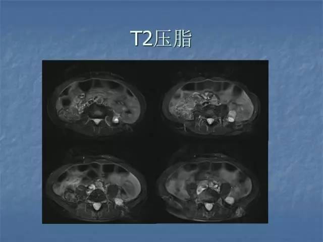 【病例】左肾上极、肾门及髂腰肌多发副神经节瘤1例MR