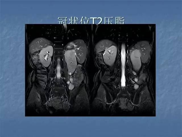 【病例】左肾上极、肾门及髂腰肌多发副神经节瘤1例MR