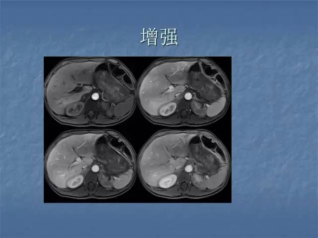 【病例】左肾上极、肾门及髂腰肌多发副神经节瘤1例MR