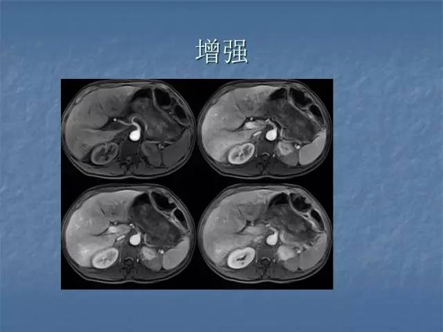 【病例】左肾上极、肾门及髂腰肌多发副神经节瘤1例MR
