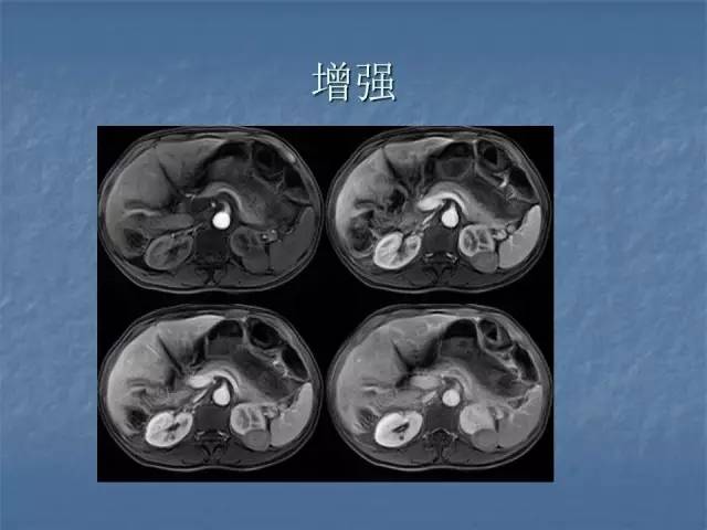 【病例】左肾上极、肾门及髂腰肌多发副神经节瘤1例MR