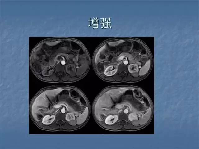 【病例】左肾上极、肾门及髂腰肌多发副神经节瘤1例MR