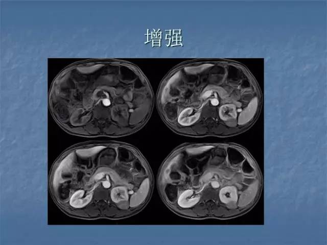 【病例】左肾上极、肾门及髂腰肌多发副神经节瘤1例MR