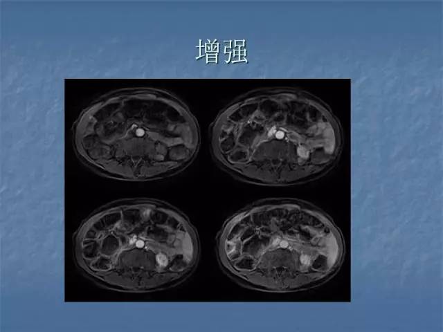 【病例】左肾上极、肾门及髂腰肌多发副神经节瘤1例MR