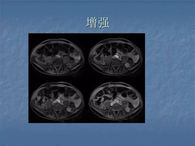【病例】左肾上极、肾门及髂腰肌多发副神经节瘤1例MR