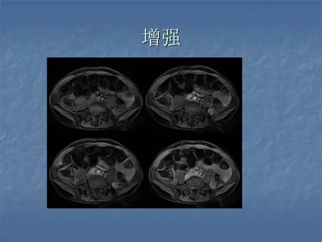 【病例】左肾上极、肾门及髂腰肌多发副神经节瘤1例MR
