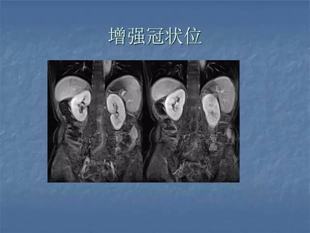 【病例】左肾上极、肾门及髂腰肌多发副神经节瘤1例MR