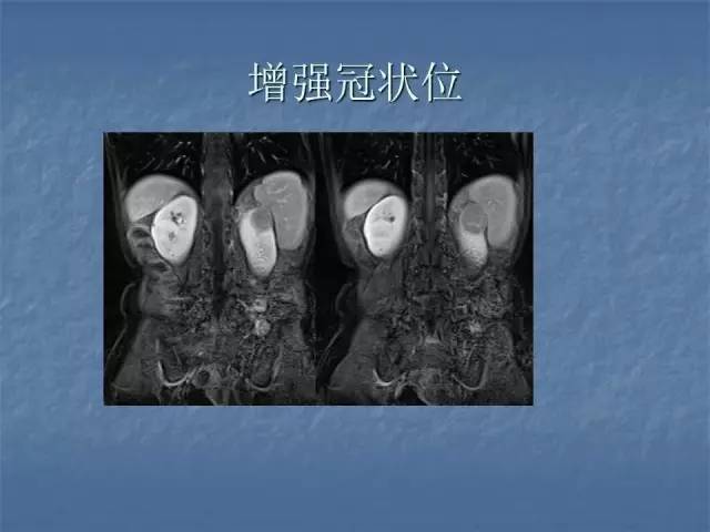 【病例】左肾上极、肾门及髂腰肌多发副神经节瘤1例MR