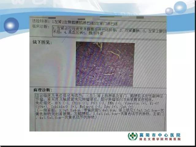【病例】左肾上极、肾门及髂腰肌多发副神经节瘤1例MR