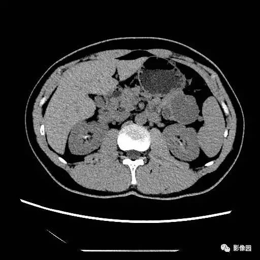 【病例】胰腺内异位脾伴异位脾表皮样囊肿一例CT 【病例】胰腺内异位脾伴异位脾表皮样囊肿一例CT