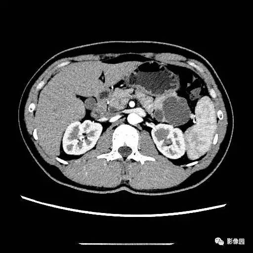 【病例】胰腺内异位脾伴异位脾表皮样囊肿一例CT 【病例】胰腺内异位脾伴异位脾表皮样囊肿一例CT