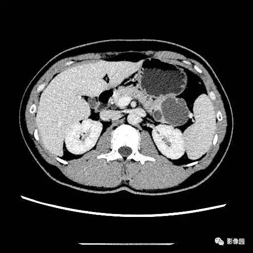 【病例】胰腺内异位脾伴异位脾表皮样囊肿一例CT 【病例】胰腺内异位脾伴异位脾表皮样囊肿一例CT