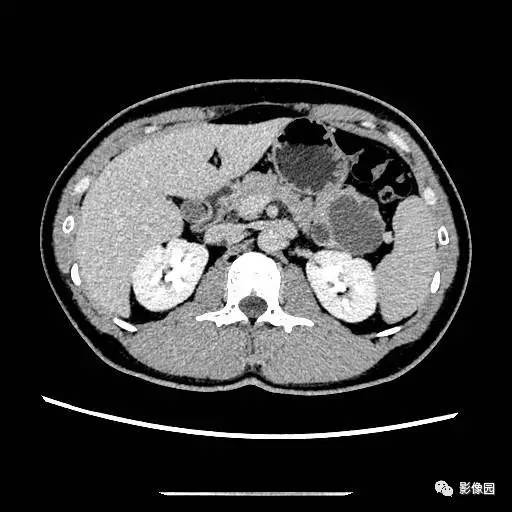 【病例】胰腺内异位脾伴异位脾表皮样囊肿一例CT