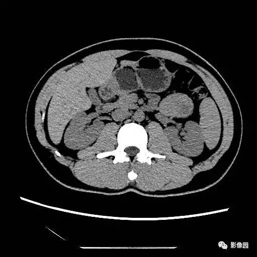 【病例】胰腺内异位脾伴异位脾表皮样囊肿一例CT 【病例】胰腺内异位脾伴异位脾表皮样囊肿一例CT