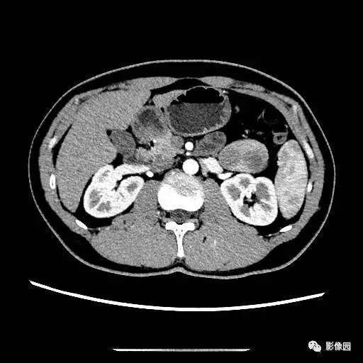 【病例】胰腺内异位脾伴异位脾表皮样囊肿一例CT 【病例】胰腺内异位脾伴异位脾表皮样囊肿一例CT